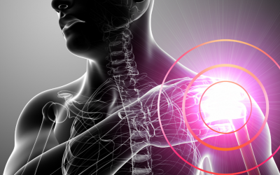 Image shows the body and bones of a shoulder joint. The frozen shoulder radiates pain as shown with pink light