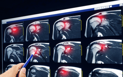 Image shows a surgeon looking at MRI scan of an injured shoulder before rotator cuff surgery