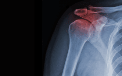 Fractured shoulder X-Ray